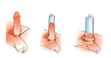 Penis büyütme için bir pompanın çalışma prensibi